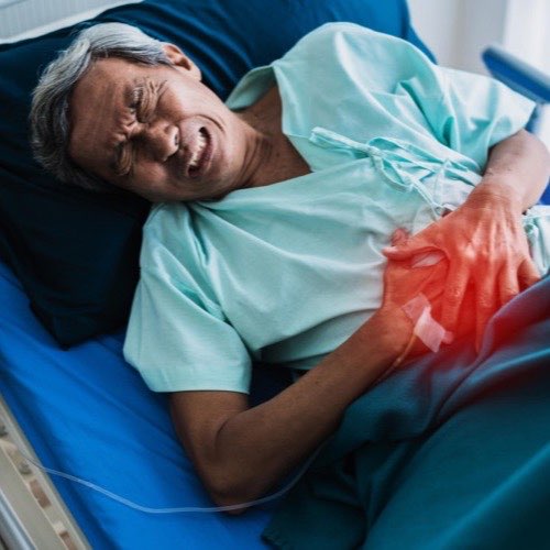 Appendectomy