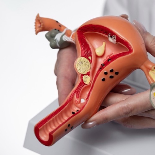 Bartholin Cyst