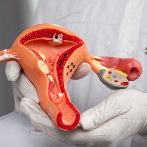 Chocolate Cyst (Endometrioma)