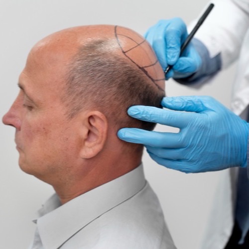 Hair Transplant