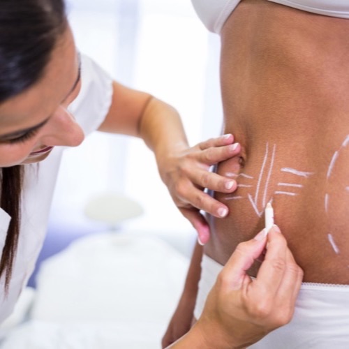 Liposuction