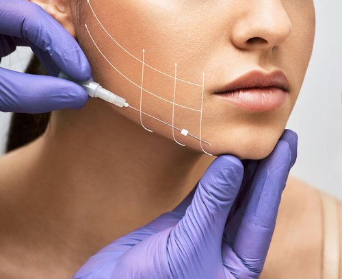 Face Thread Lift