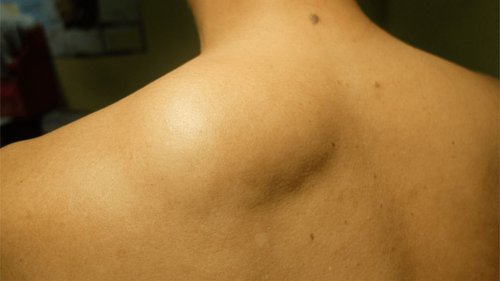 Lipoma Removal