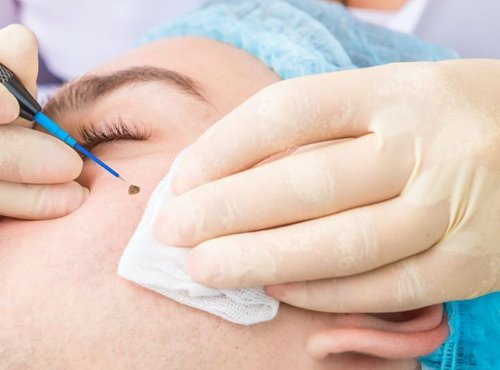 Mole Removal
