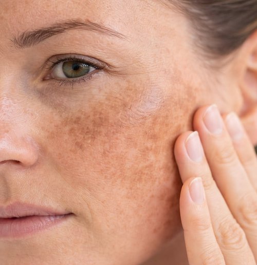 Pigmentation Treatment