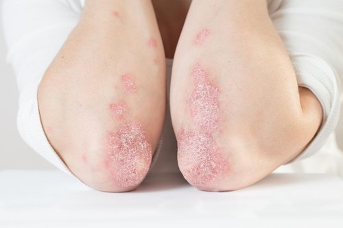 Psoriasis Treatment