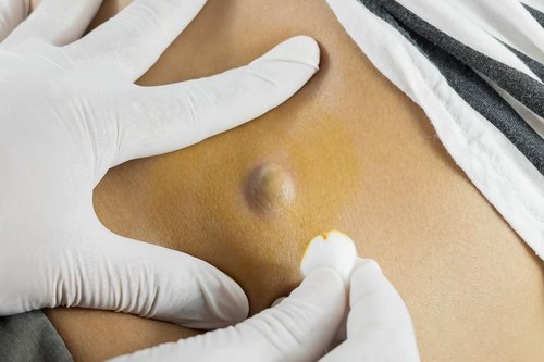 Sebaceous Cyst Removal