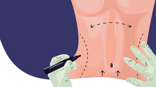 Tummy Tuck (Abdominoplasty)