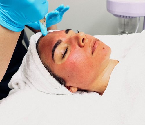 Vampire Facial (PRP Microneedling)