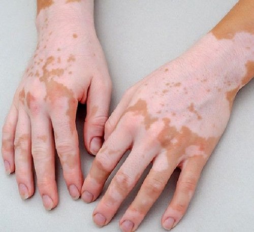Vitiligo Treatment