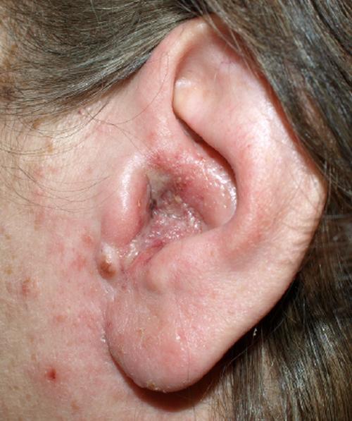 Otitis Externa
