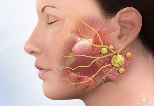 Salivary Gland Stones