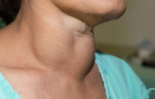 Thyroid Nodule