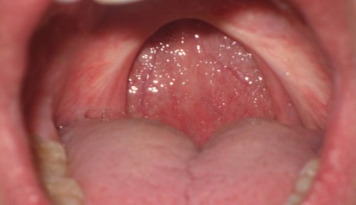 Uvulopalatopharyngoplasty (UPPP)