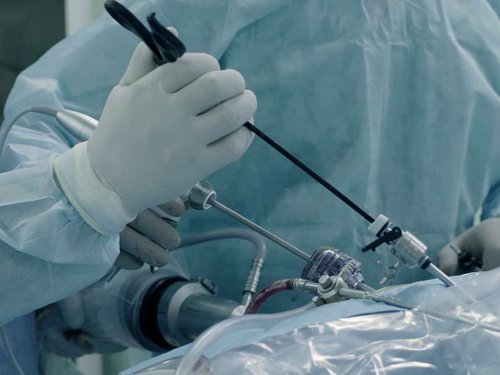 Laparoscopy for Infertility
