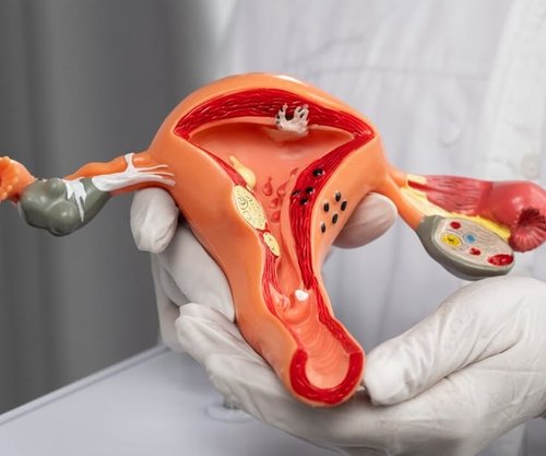 Ovarian Cystectomy