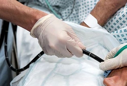 Polypectomy