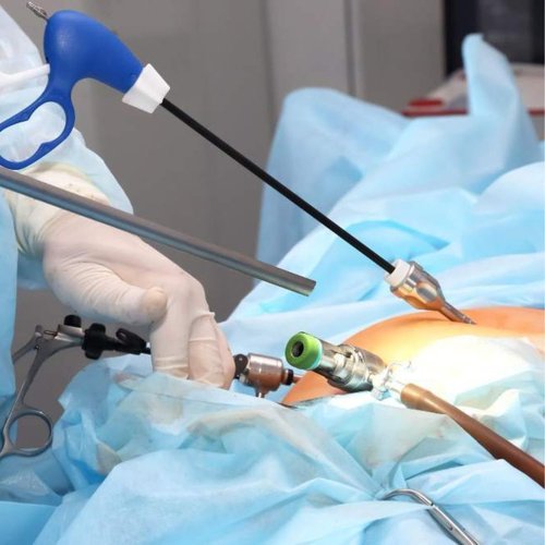 Diagnostic Laparoscopy