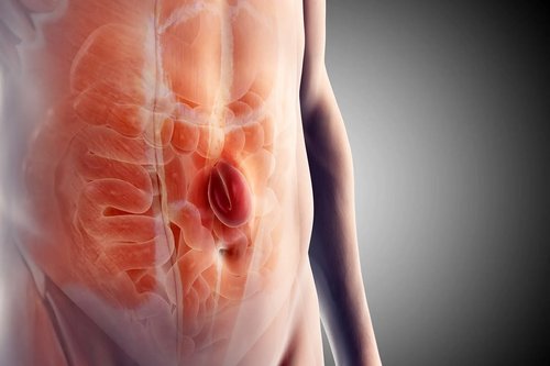 Umbilical Hernia