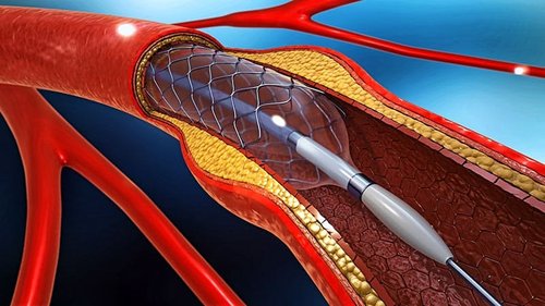 DJ Stent Placement