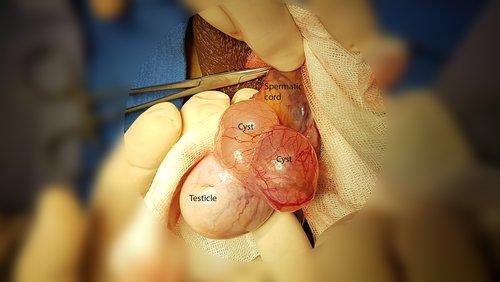 Epididymal Cyst