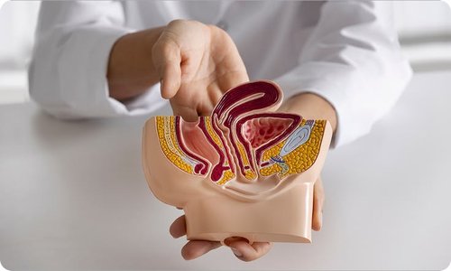 Hydrocele