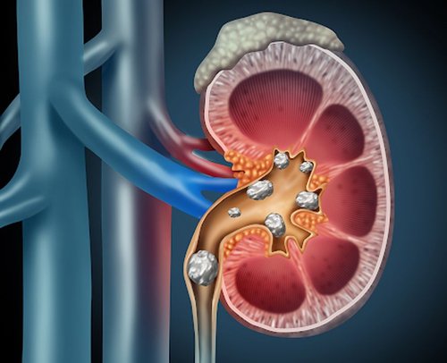 Kidney Stones