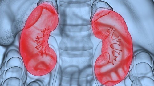 Nephrostomy
