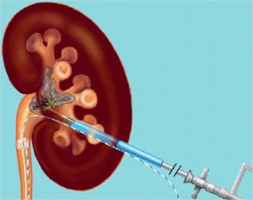 PCNL (Percutaneous Nephrolithotomy)