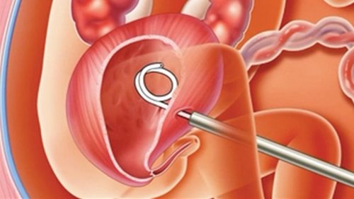 URSL (Ureteroscopic Lithotripsy)