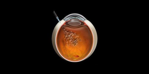 Intravitreal Injection