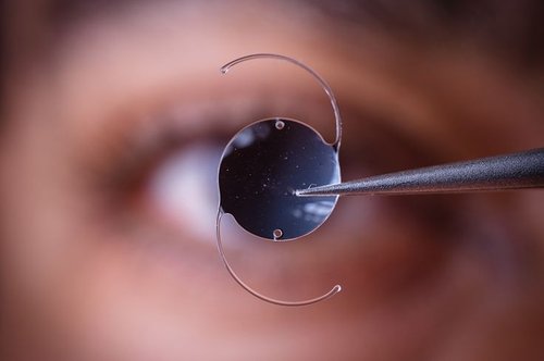 Monofocal Lens Implant