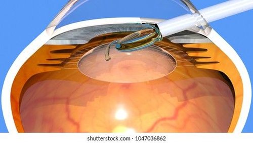 Phacoemulsification