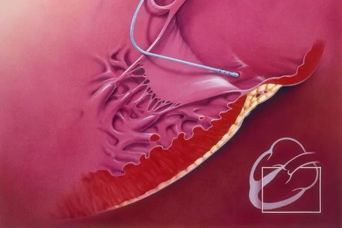 PRK / Surface Ablation