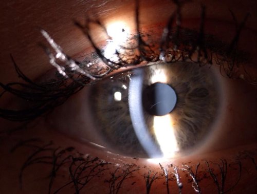 Vitrectomy