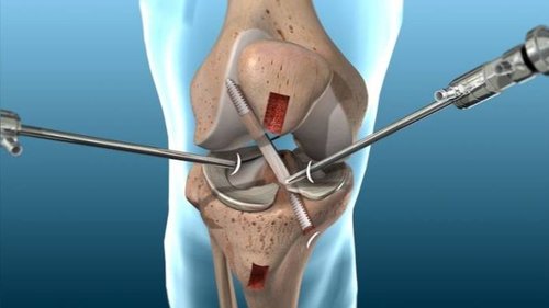 Knee Arthroscopy