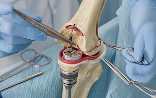 Partial Knee Replacement