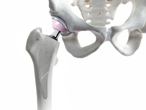 Revision Hip Replacement