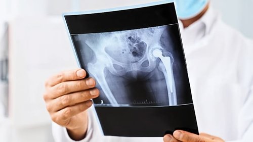 Revision Knee Replacement