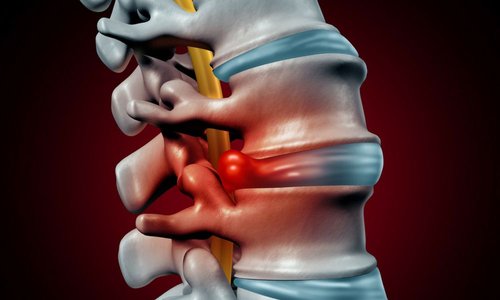 Slipped (Herniated) Disc