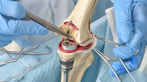 Total Knee Replacement
