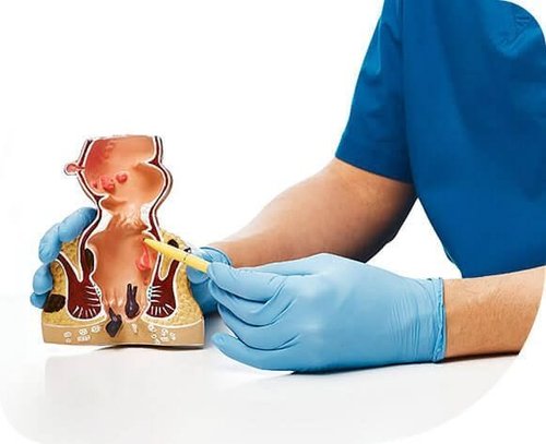 Laser Fistula Treatment