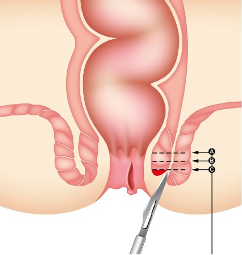 Lateral Internal Sphincterotomy