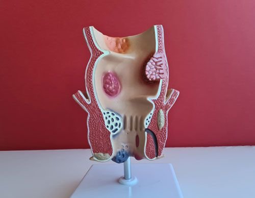 Rectal Polyps
