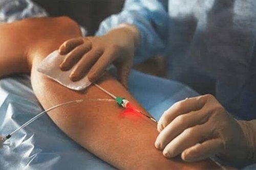 Endovenous Laser Ablation (EVLT)