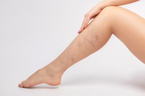Spider Veins Treatment