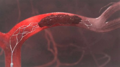Thrombectomy