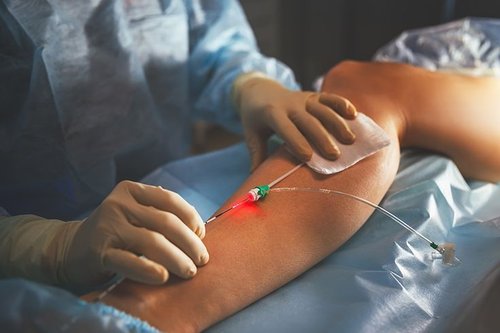 Varicose Veins Treatment
